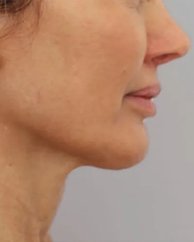 Profound RF skin tightening Amsterdam - after photo of the jawline and neck in profile Jawline and neck in profile after Profound RF skin tightening at our Amsterdam clinic