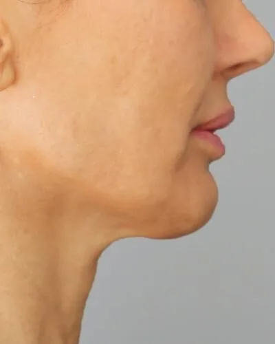 Profound RF skin tightening Amsterdam - before photo of the jawline and neck in profile Jawline and neck in profile before Profound RF skin tightening at our Amsterdam clinic